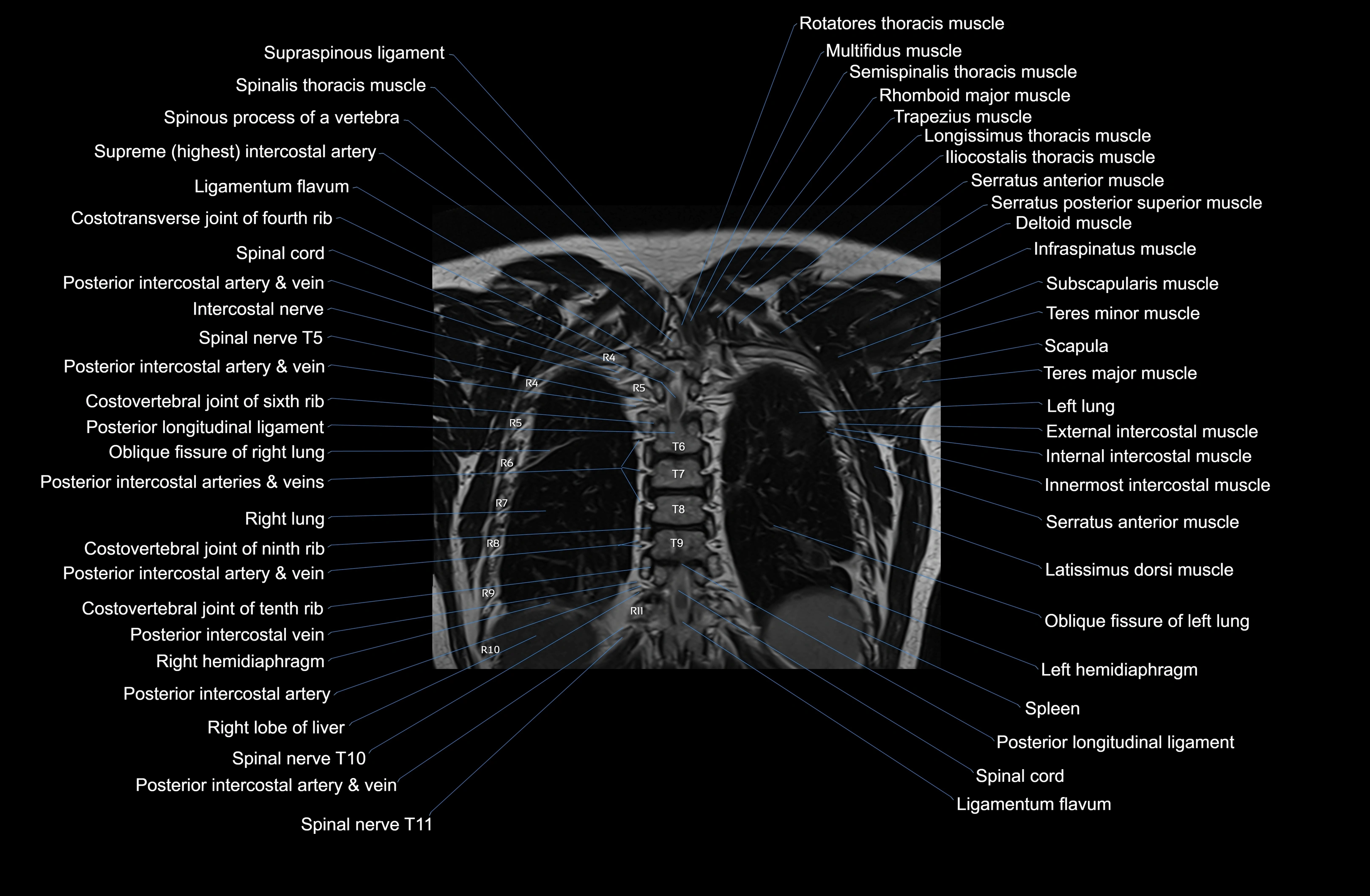 MRI chest (thorax) coronal  cross sectional anatomy 3T radiology  image-img-00001-00035.webp